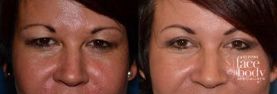 Eyelid Surgery Before & After Gallery - Patient 342441 - Image 1