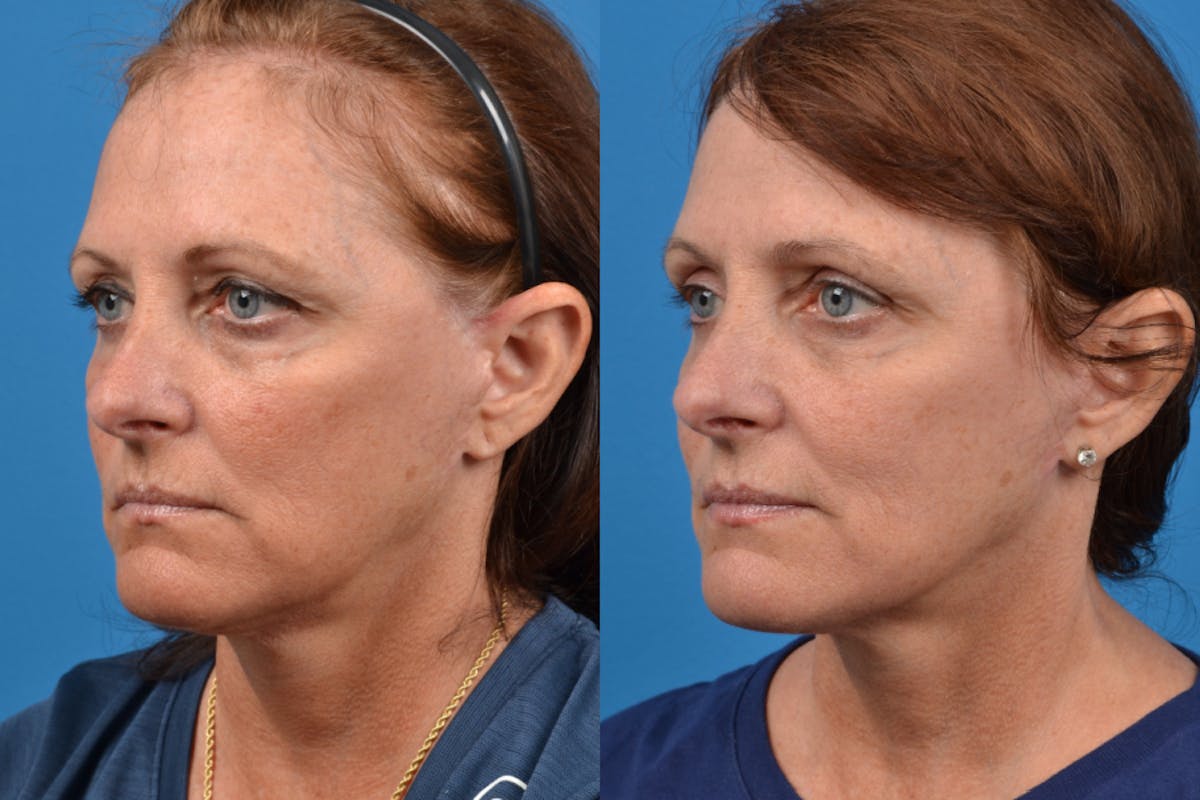 Facelift Before & After Gallery - Patient 122406107 - Image 2