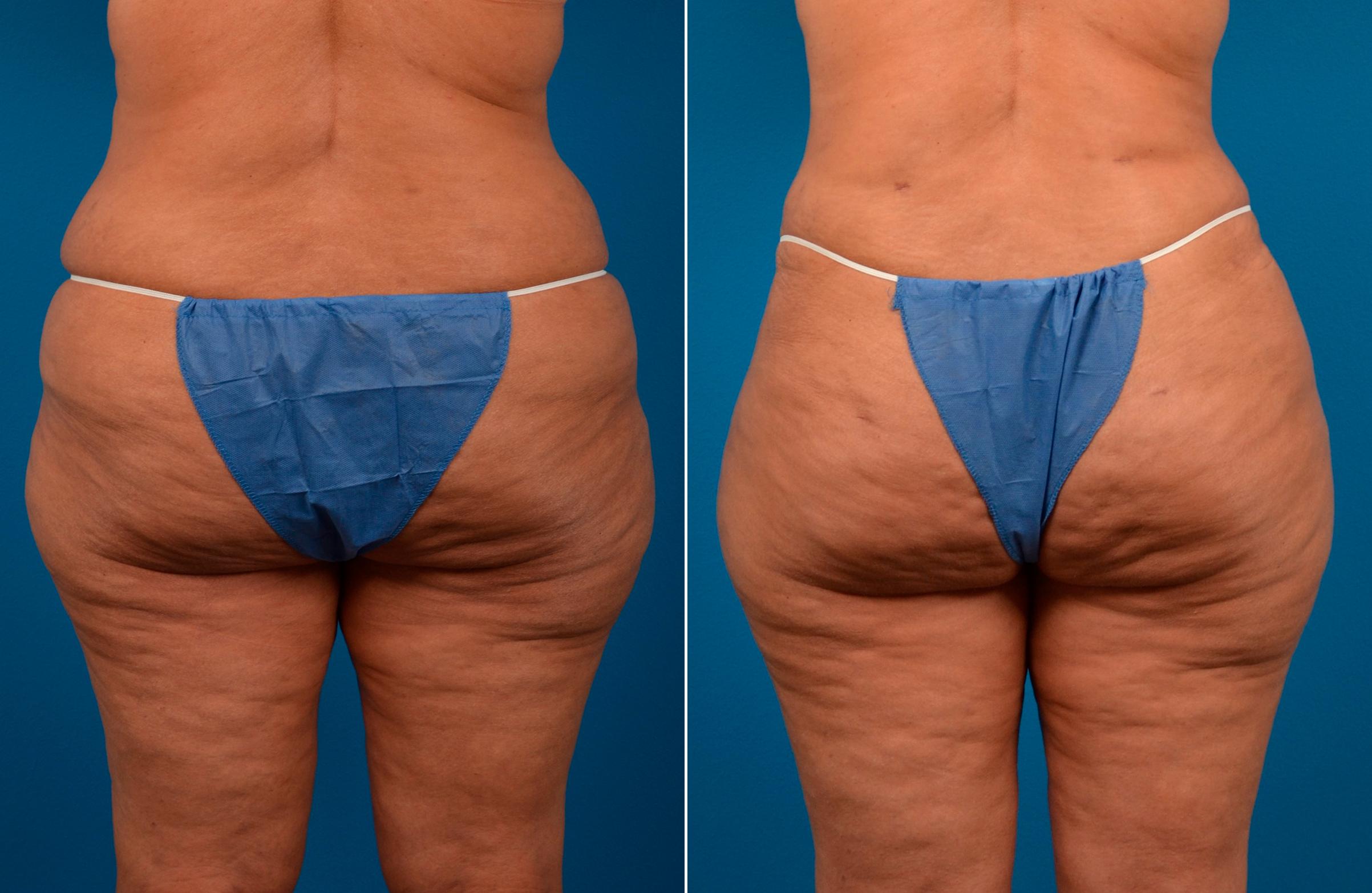 Hidden Liposuction  Before & After Gallery - Patient 250022 - Image 1