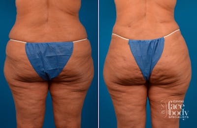 Hidden Liposuction  Before & After Gallery - Patient 250022 - Image 1