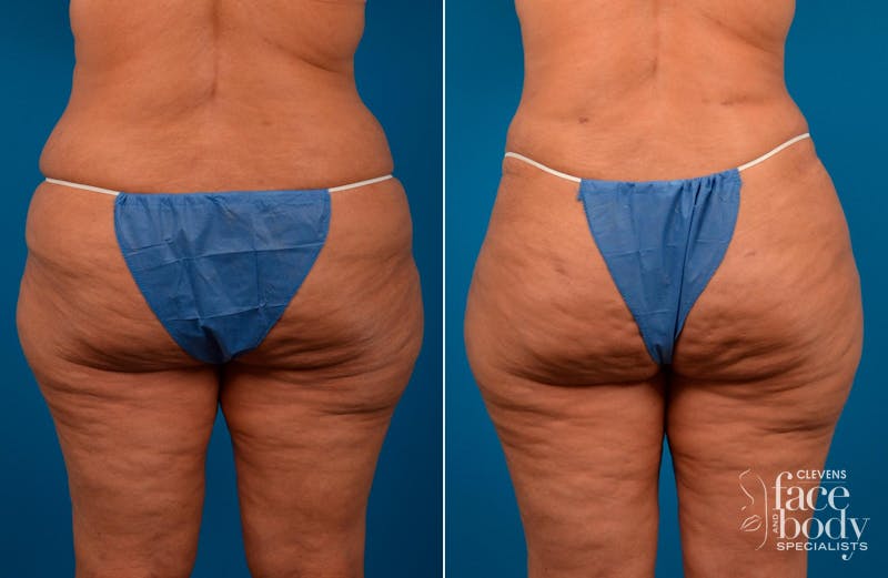 Hidden Liposuction Before & After Gallery - Patient 250022 - Image 1
