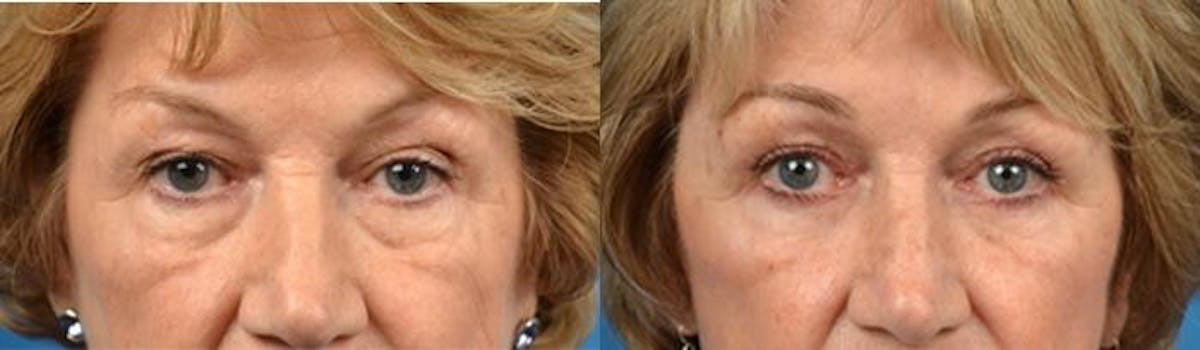 Eyelid Surgery Before & After Gallery - Patient 122406108 - Image 1