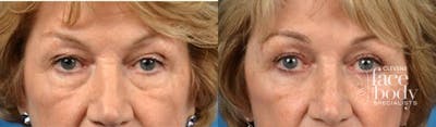 Eyelid Surgery Before & After Gallery - Patient 285703 - Image 1