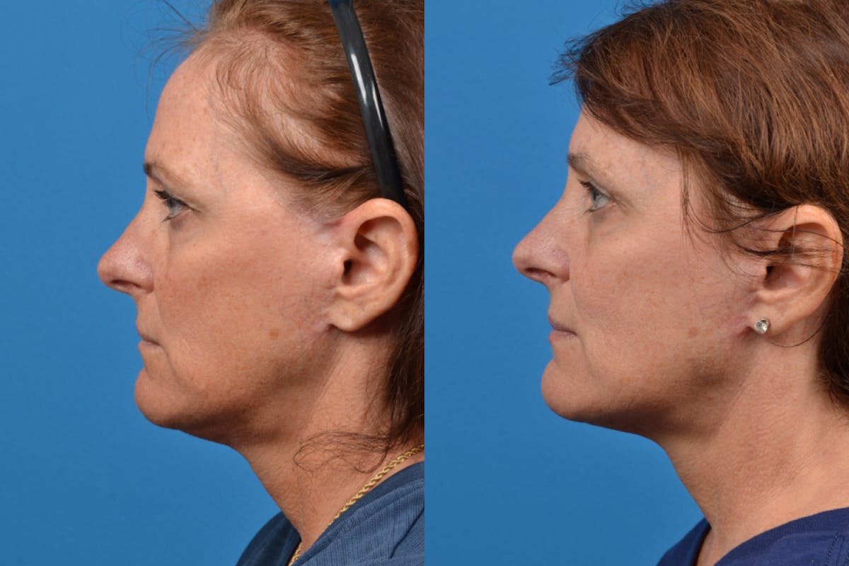 Facelift Before & After Gallery - Patient 122406107 - Image 3