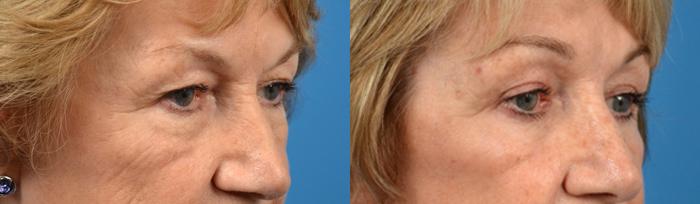 Eyelid Surgery Before & After Gallery - Patient 285703 - Image 2