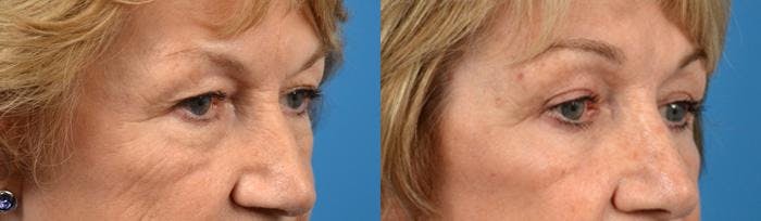 Eyelid Surgery Before & After Gallery - Patient 122406108 - Image 2