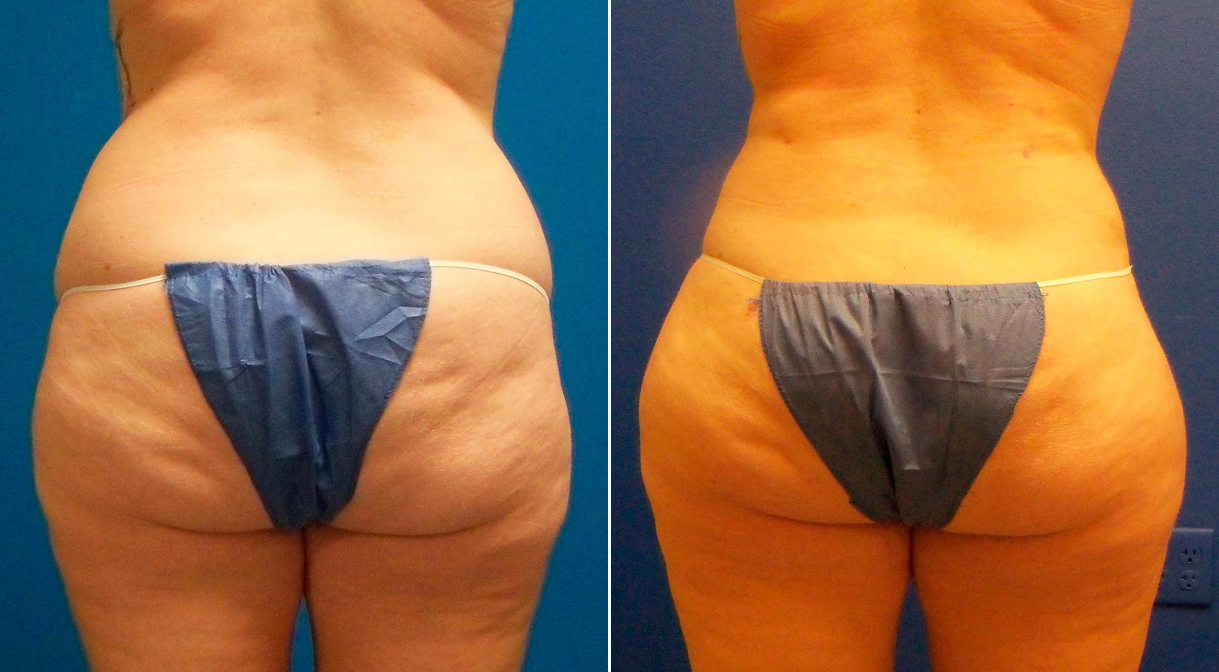 Hidden Liposuction  Before & After Gallery - Patient 367035 - Image 1