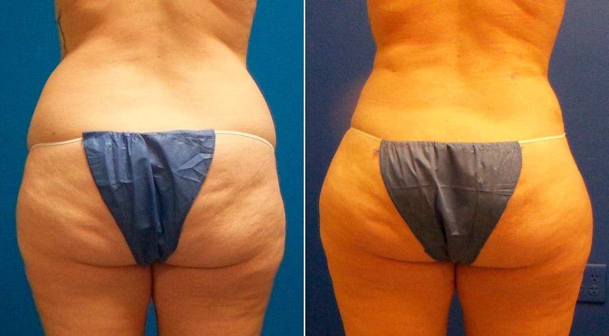 Liposuction Before & After Gallery - Patient 399722 - Image 1