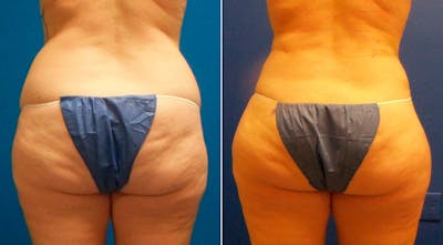Liposuction Before & After Gallery - Patient 399722 - Image 1