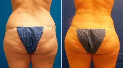Hidden Liposuction  Before & After Gallery - Patient 367035 - Image 1