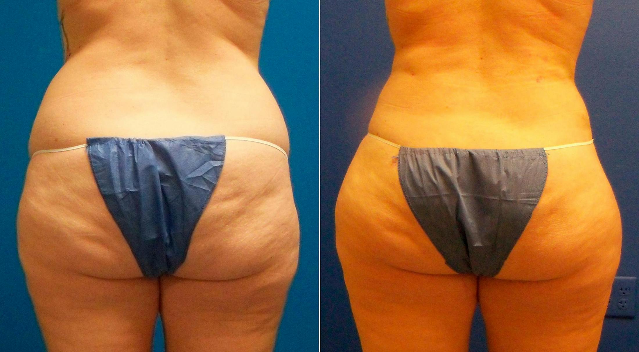 Liponique Body Contouring Before & After Gallery - Patient 122406106 - Image 1