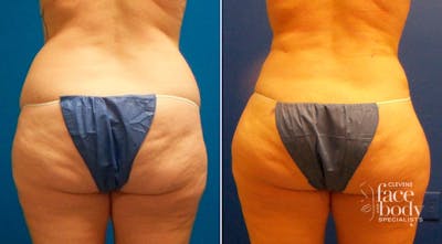 Hidden Liposuction  Before & After Gallery - Patient 367035 - Image 1