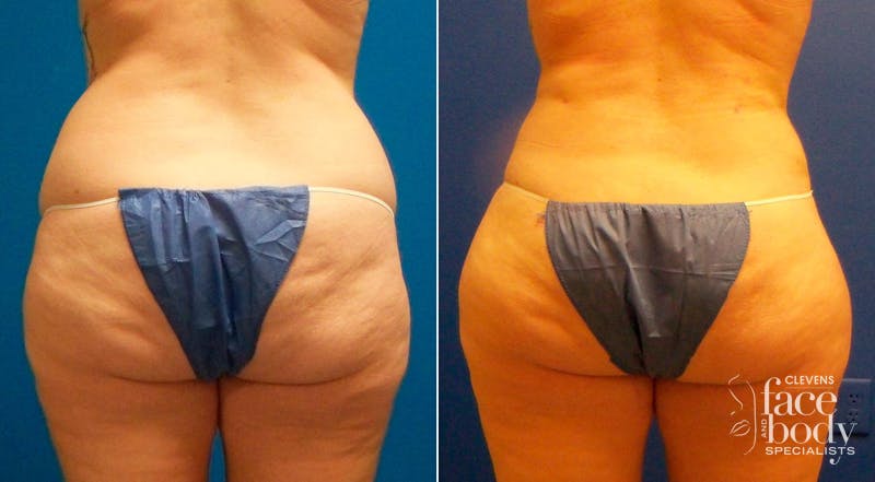 Hidden Liposuction  Before & After Gallery - Patient 367035 - Image 1