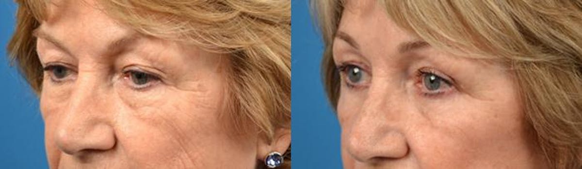 Eyelid Surgery Before & After Gallery - Patient 122406108 - Image 3