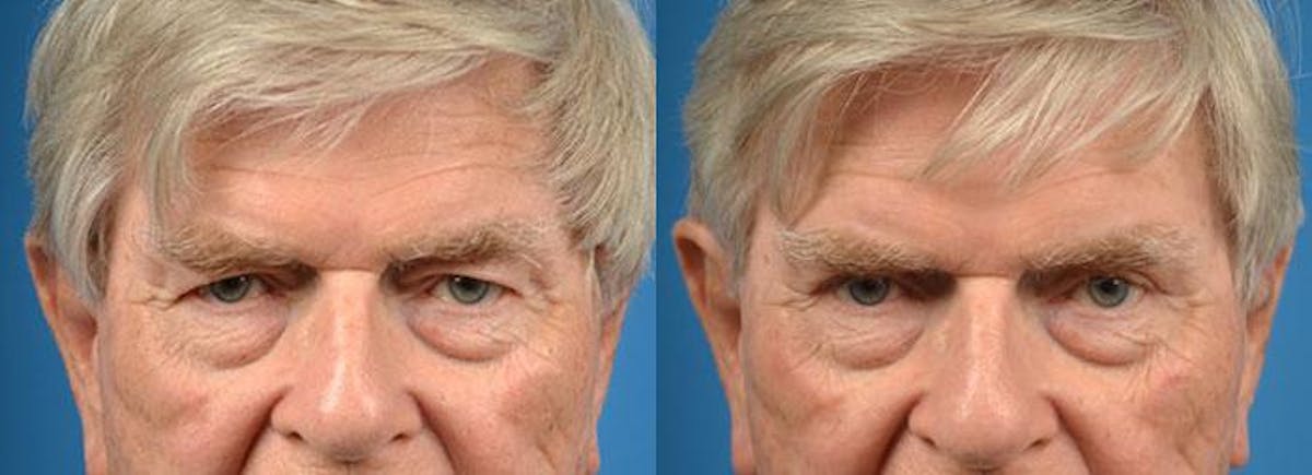 Eyelid Surgery Before & After Gallery - Patient 122406110 - Image 1