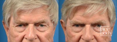 Eyelid Surgery Before & After Gallery - Patient 252472 - Image 1