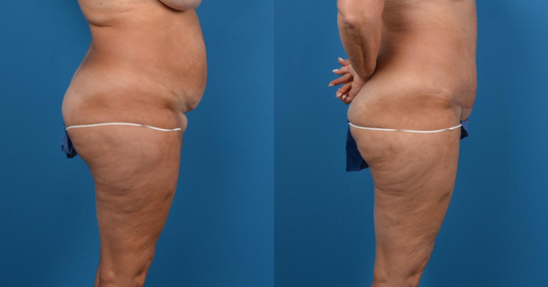 Hidden Liposuction  Before & After Gallery - Patient 389201 - Image 2
