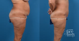 Hidden Liposuction Before & After Gallery - Patient 389201 - Image 2