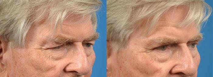 Eyelid Surgery Gallery - Patient 122406110 - Image 2