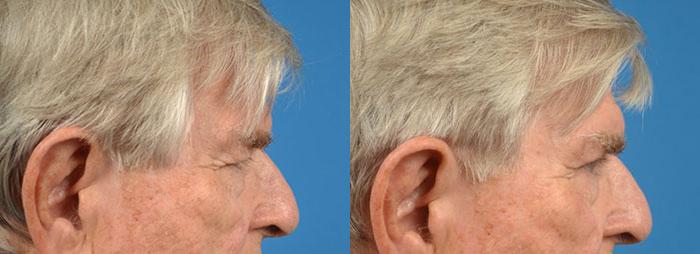 Eyelid Surgery Before & After Gallery - Patient 252472 - Image 3
