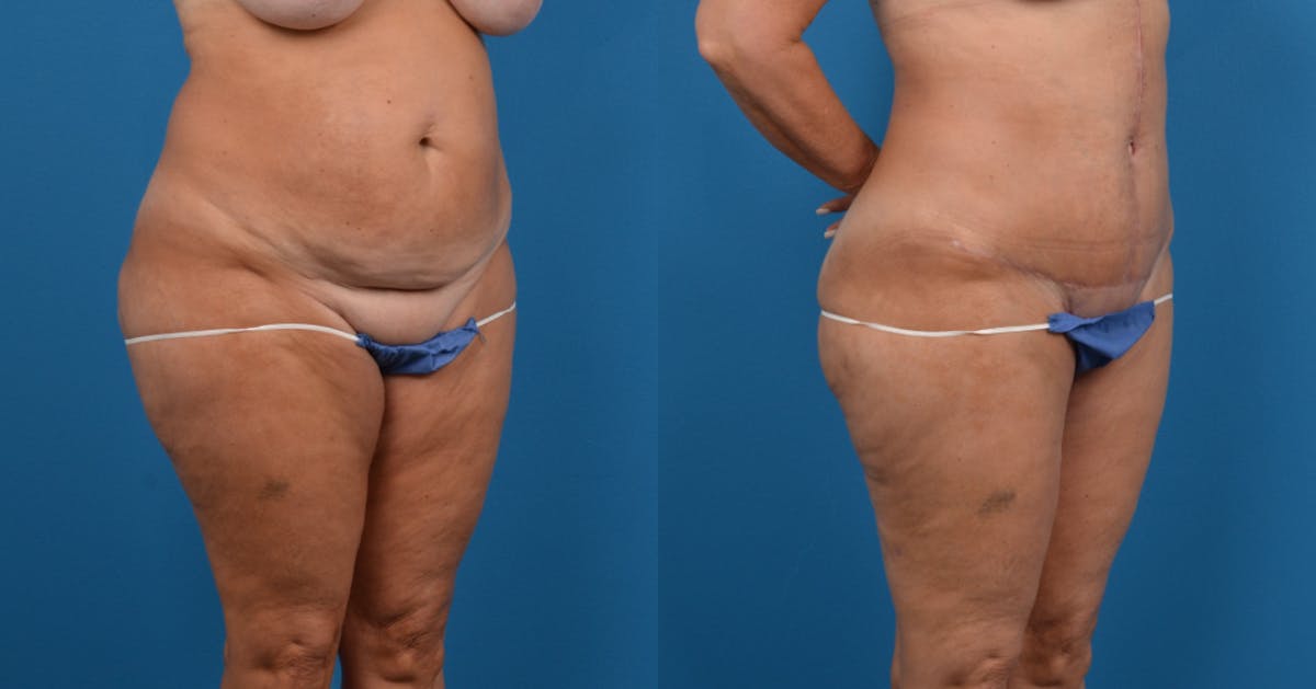 Liposuction Before & After Gallery - Patient 298665 - Image 3