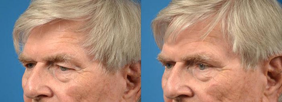 Eyelid Surgery Before & After Gallery - Patient 122406110 - Image 4