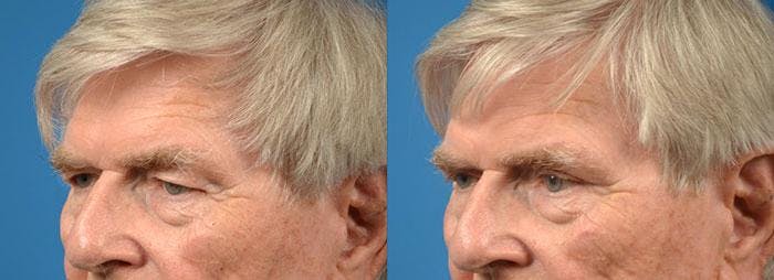 Eyelid Surgery Before & After Gallery - Patient 122406110 - Image 4