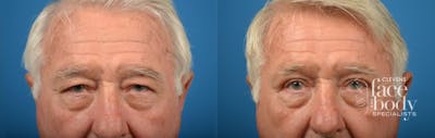 Eyelid Surgery Before & After Gallery - Patient 776849 - Image 1