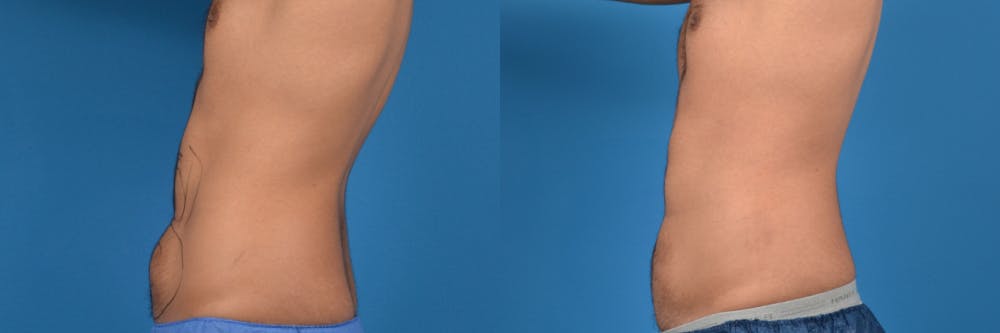 Liponique Body Contouring Before & After Gallery - Patient 122406112 - Image 2