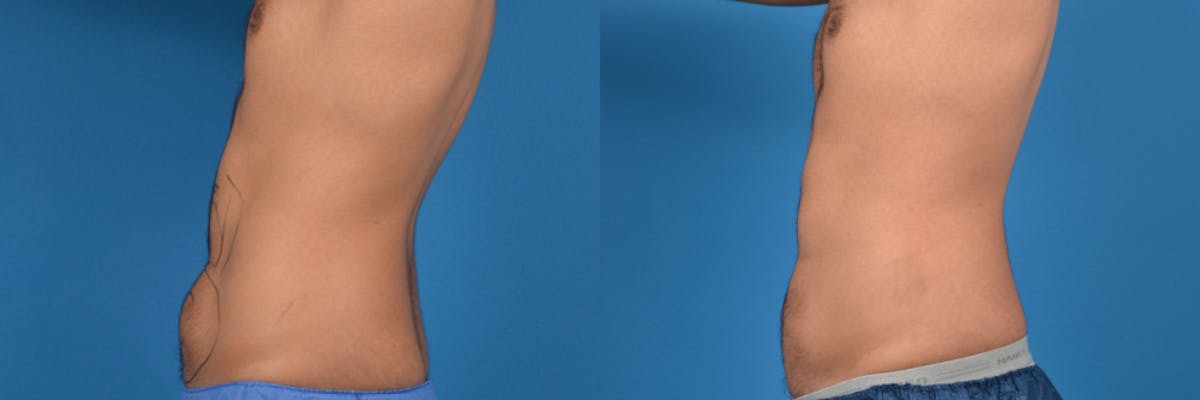 Liposuction Before & After Gallery - Patient 803607 - Image 2