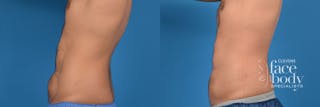 Hidden Liposuction Before & After Gallery - Patient 211642 - Image 2
