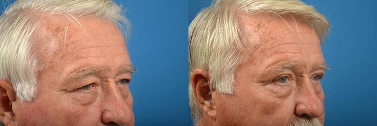 Eyelid Surgery Before & After Gallery - Patient 122406113 - Image 2