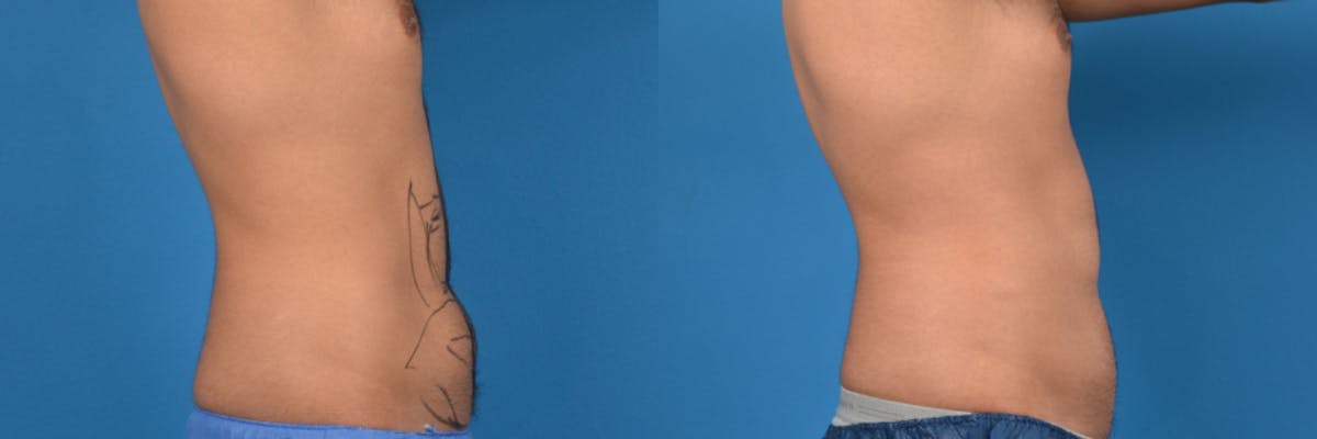 Liposuction Before & After Gallery - Patient 803607 - Image 3