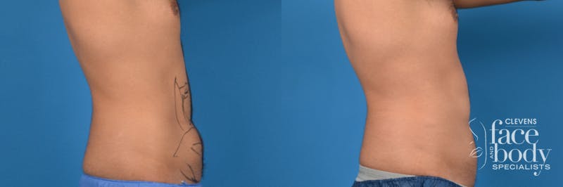 Hidden Liposuction Before & After Gallery - Patient 211642 - Image 3