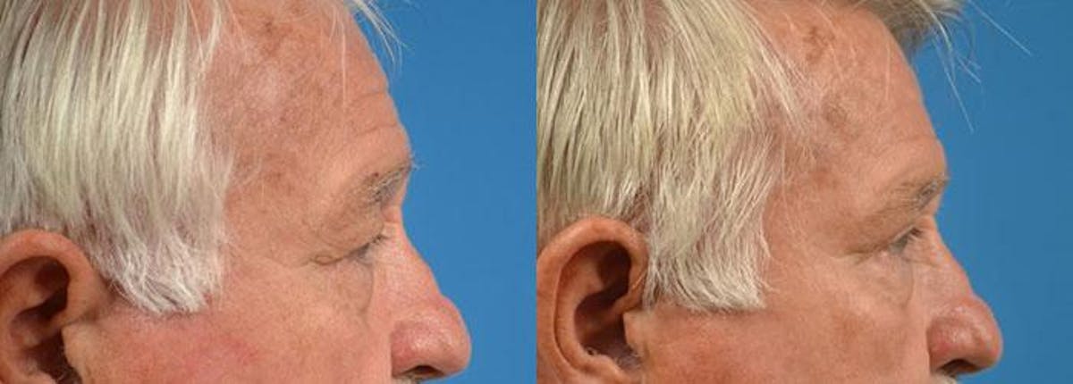 Eyelid Surgery Before & After Gallery - Patient 122406113 - Image 3