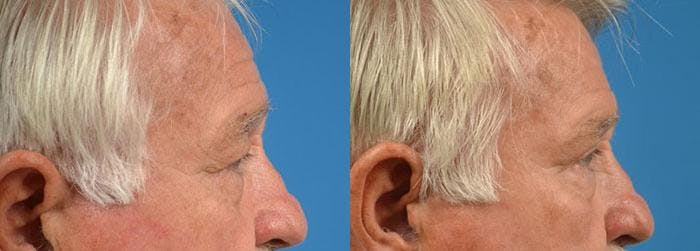 Eyelid Surgery Before & After Gallery - Patient 122406113 - Image 3