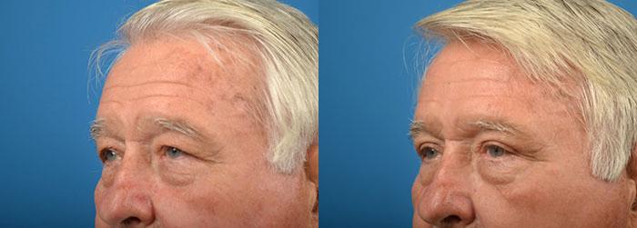 Eyelid Surgery Before & After Gallery - Patient 776849 - Image 4
