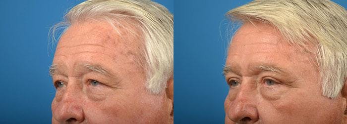 Eyelid Surgery Before & After Gallery - Patient 122406113 - Image 4