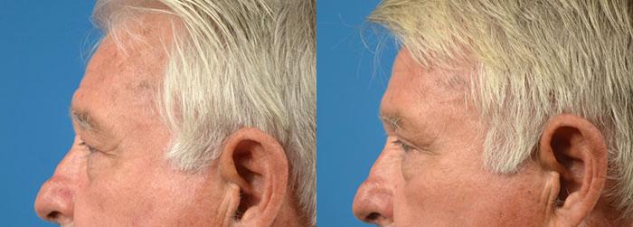 Eyelid Surgery Before & After Gallery - Patient 776849 - Image 5