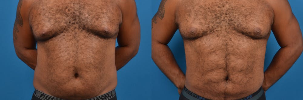 Liponique Body Contouring Before & After Gallery - Patient 122406115 - Image 1