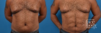Hidden Liposuction  Before & After Gallery - Patient 267011 - Image 1