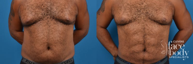 Hidden Liposuction Before & After Gallery - Patient 267011 - Image 1