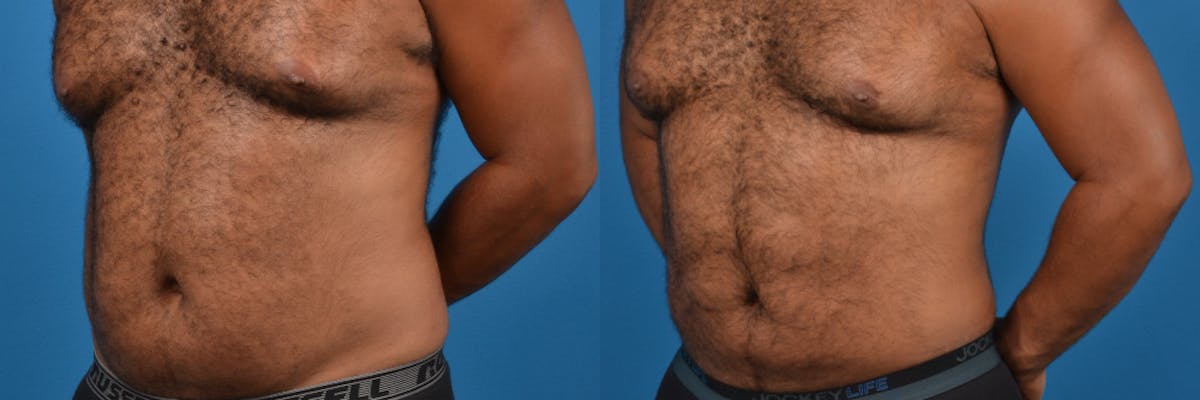 Liposuction Before & After Gallery - Patient 290041 - Image 2