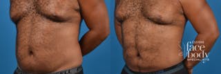 Hidden Liposuction Before & After Gallery - Patient 267011 - Image 2