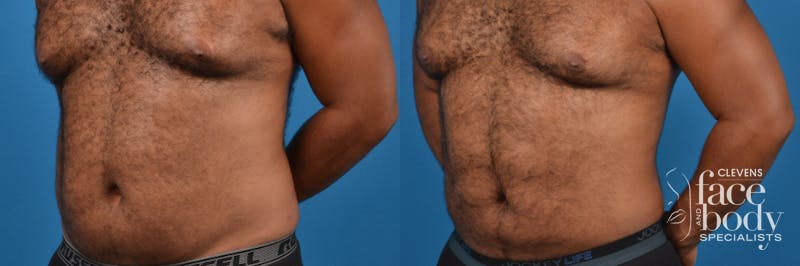 Hidden Liposuction Before & After Gallery - Patient 267011 - Image 2