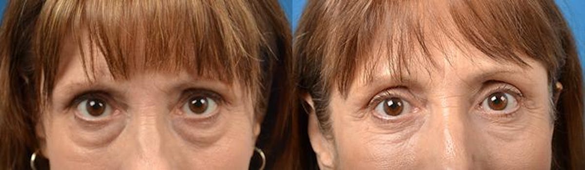 Eyelid Surgery Before & After Gallery - Patient 122406114 - Image 1
