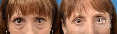 Eyelid Surgery Before & After Gallery - Patient 197452 - Image 1
