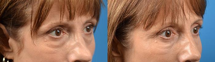 Eyelid Surgery Before & After Gallery - Patient 197452 - Image 2