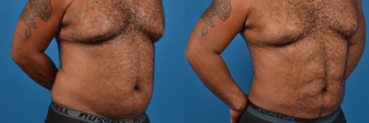 Liposuction Before & After Gallery - Patient 290041 - Image 3