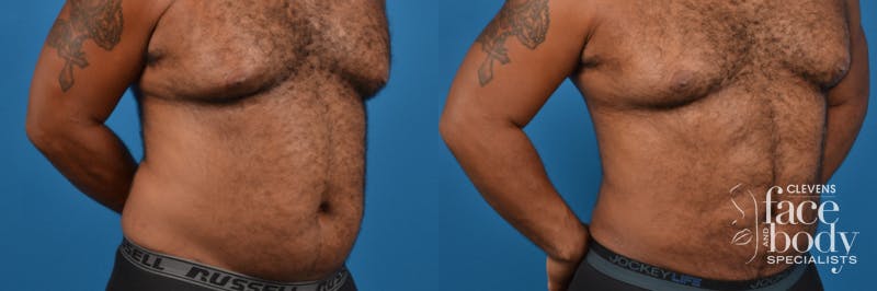Hidden Liposuction Before & After Gallery - Patient 267011 - Image 3